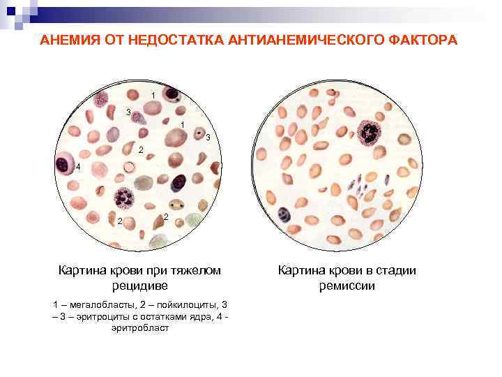 Картина крови при опга