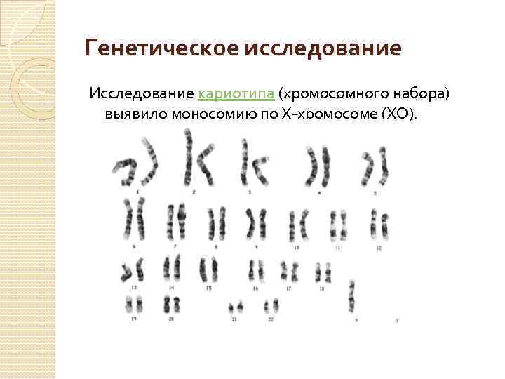 Генетическое исследование Исследование кариотипа (хромосомного набора) выявило моносомию по Х-хромосоме (ХО). 