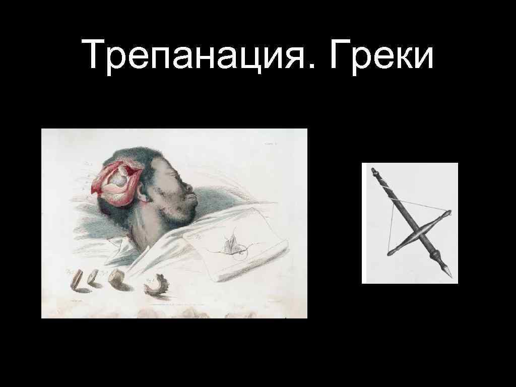 Трепанация. Греки 