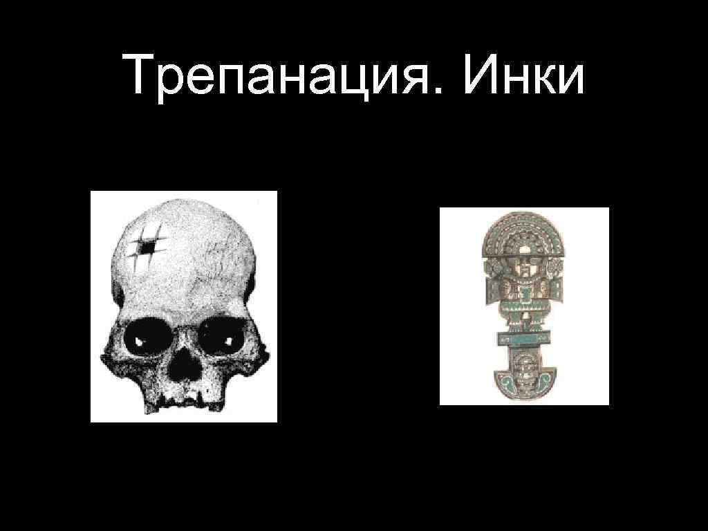 Трепанация. Инки 