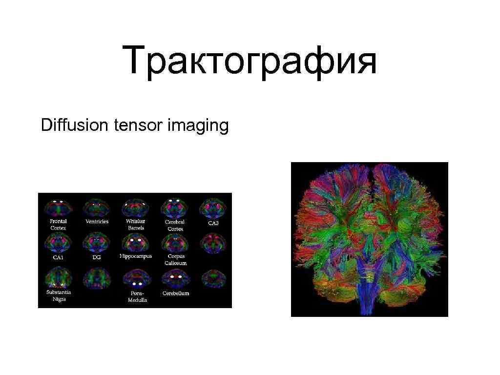 Трактография Diffusion tensor imaging 
