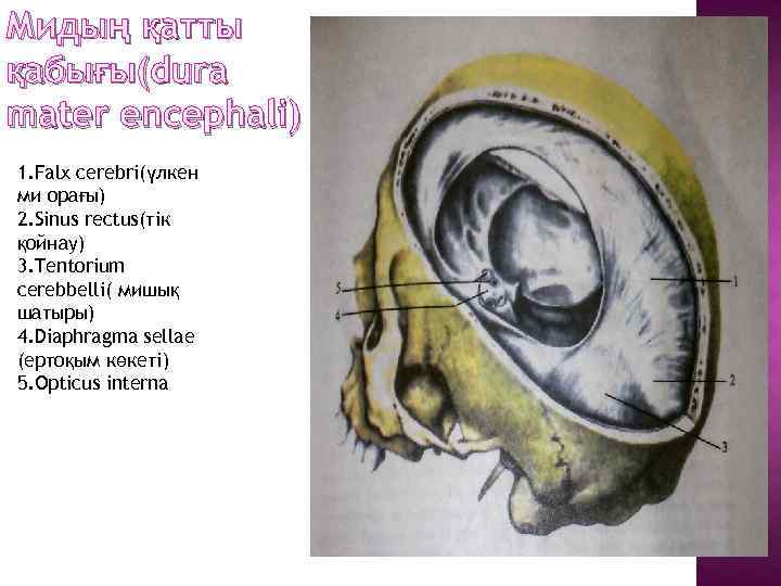 Мидың қатты қабығы(dura mater encephali) 1. Falx cerebri(үлкен ми орағы) 2. Sinus rectus(тік қойнау)