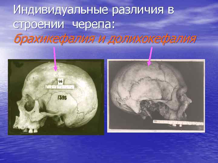 Индивидуальные различия в строении черепа: брахикефалия и долихокефалия 