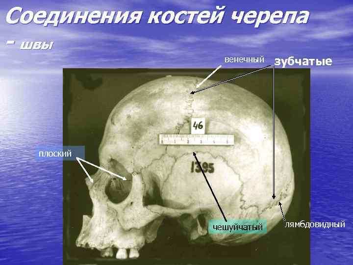 Подвижные соединения костей черепа. Швы черепа венечный Сагиттальный ламбдовидный чешуйчатый. Швы костей черепа. Швы черепа зубчатый чешуйчатый плоский. Соединение костей черепа швы.