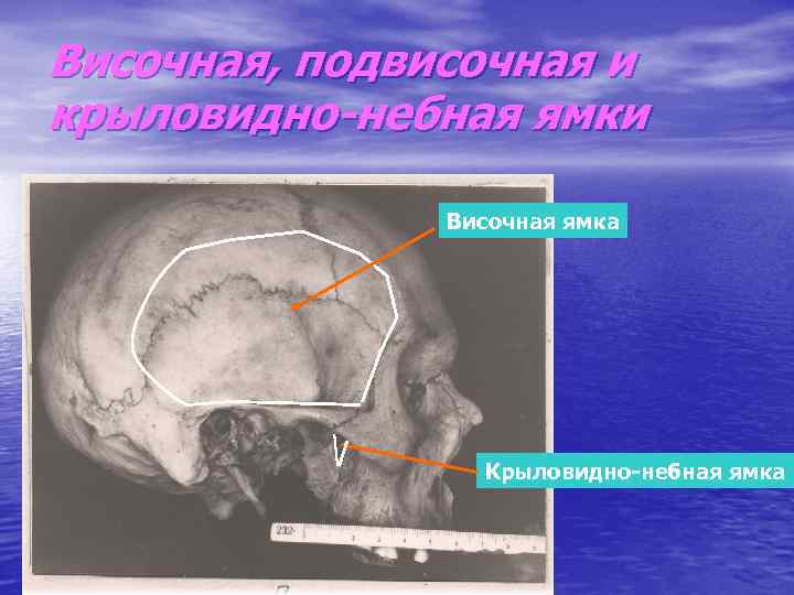 Височная ямка. Височная подвисочная и крыловидно-небная ямки. Височная ямка подвисочная ямка крыловидно небная. Височная впадина. Височная нёбная ямки.