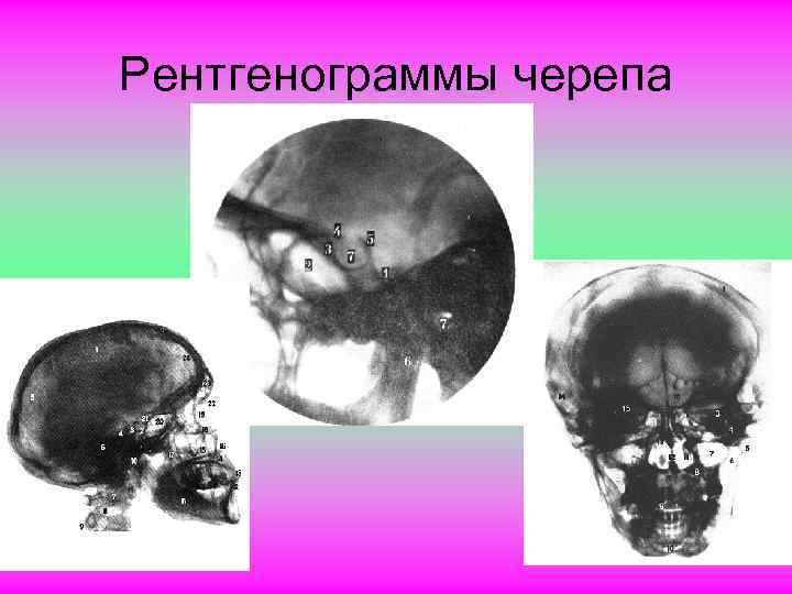 Рентгенограммы черепа 