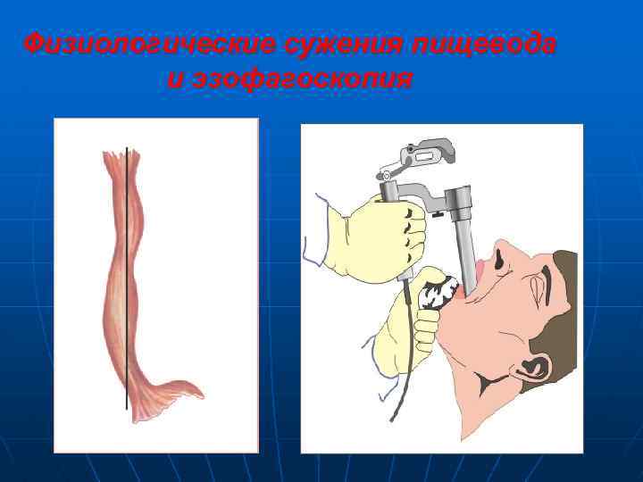Физиологические сужения пищевода и эзофагоскопия 