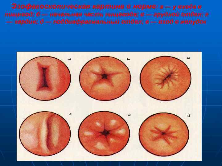 Эзофагоскопическая картина в норме: а — у входа в пищевод; б — начальная часть