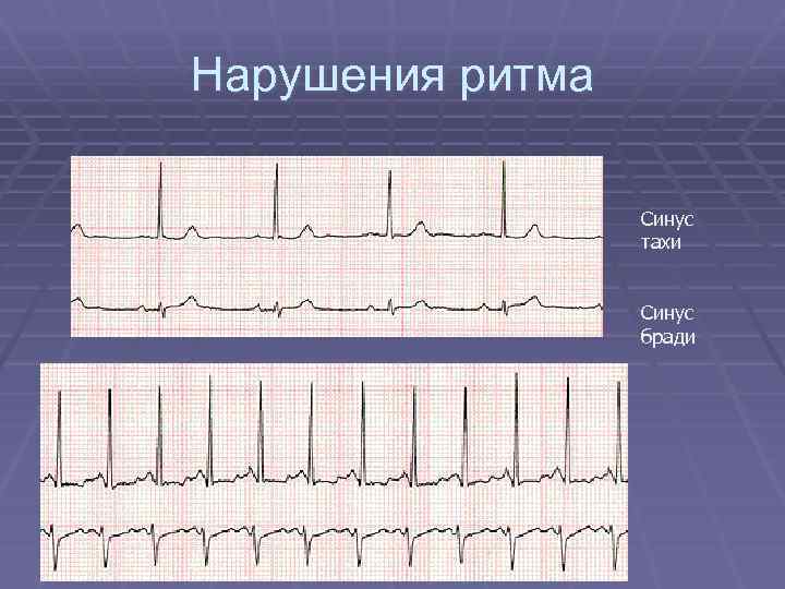 Нарушения ритма Синус тахи Синус бради 