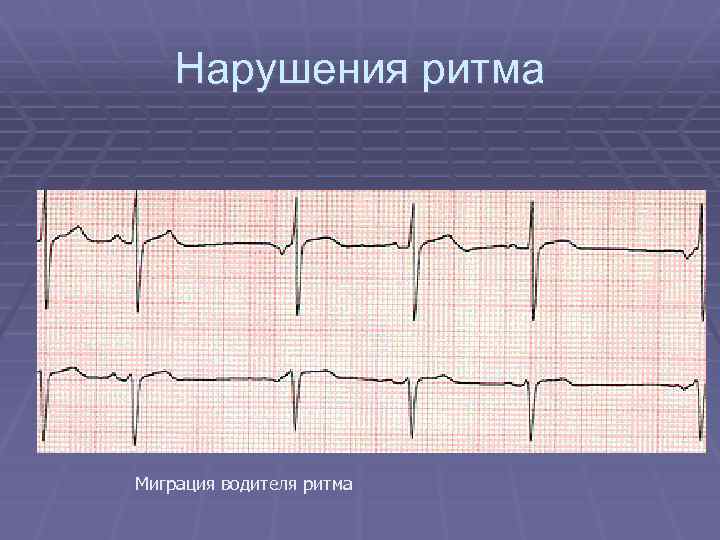 Нарушения ритма Миграция водителя ритма 