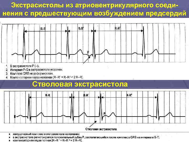 Экстрасистолы из атриовентрикулярного соединения с предшествующим возбуждением предсердий Стволовая экстрасистола 