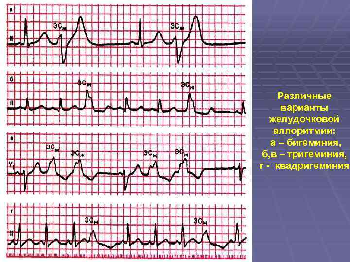 Различные варианты желудочковой аллоритмии: а – бигеминия, б, в – тригеминия, г - квадригеминия
