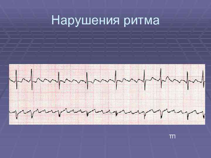 Нарушения ритма ТП 