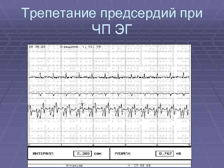 Трепетание предсердий при ЧП ЭГ 