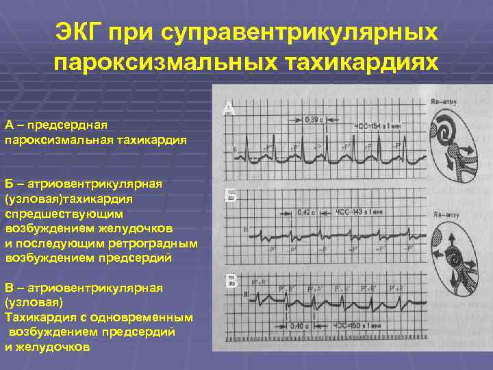 ЭКГ при суправентрикулярных пароксизмальных тахикардиях А – предсердная пароксизмальная тахикардия Б – атриовентрикулярная (узловая)тахикардия