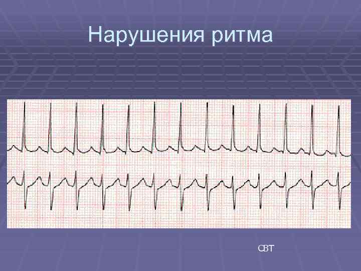 Нарушения ритма СВТ 