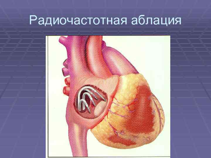 Радиочастотная аблация 