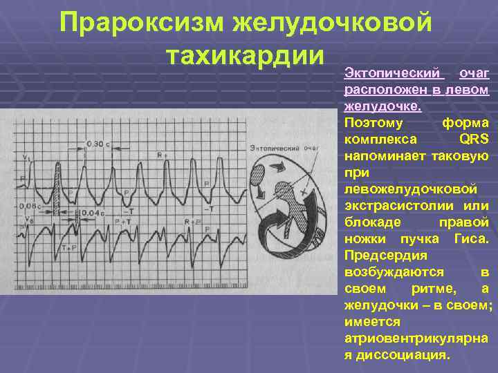 Прароксизм желудочковой тахикардии Эктопический очаг расположен в левом желудочке. Поэтому форма комплекса QRS напоминает