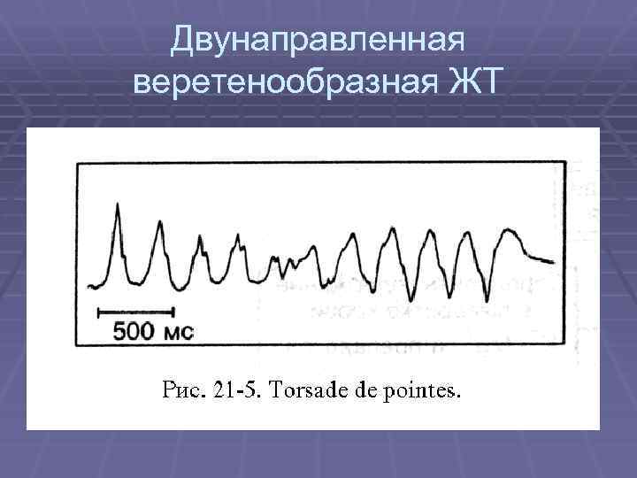 Двунаправленная веретенообразная ЖТ 