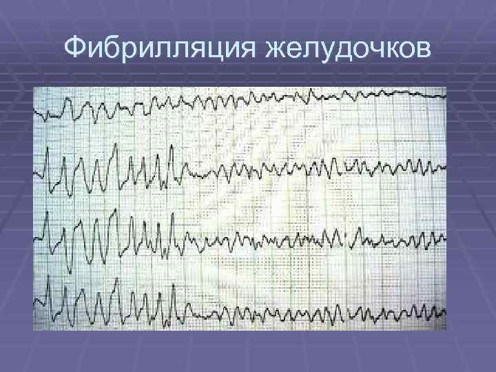 Фибрилляция желудочков 