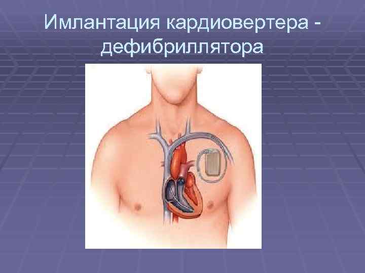 Имлантация кардиовертера дефибриллятора 