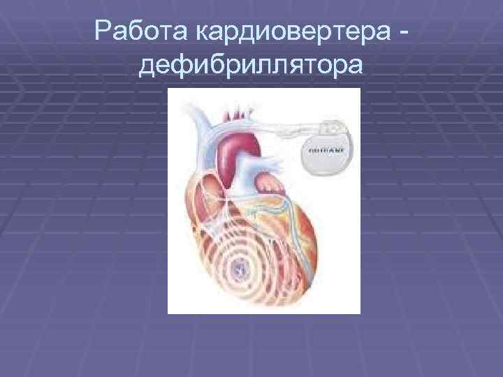 Работа кардиовертера дефибриллятора 