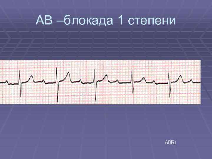 Блокада на первом. АВ-блокада 1. Блокада 1 степени. АВ блокада первой степени. Атриовентрикулярная блокада 1 степени у детей.