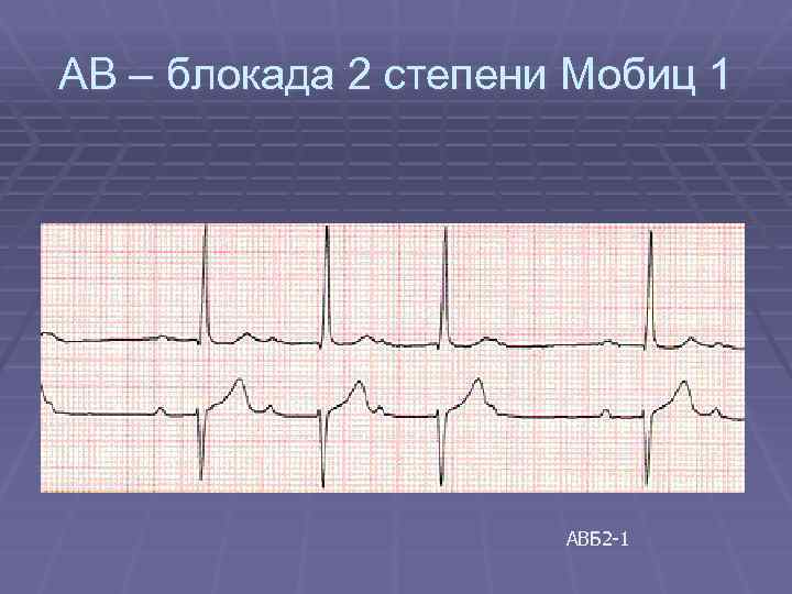 АВ – блокада 2 степени Мобиц 1 АВБ 2 -1 