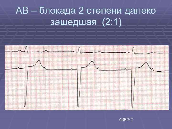 Ав блокада 2 степени. АВ блокада 2 степени Мобитц 3. Неполная АВ блокада 2 степ. Холтер АВ блокада 2:1. АВ блокада 2 степени пауза 2 секунды.