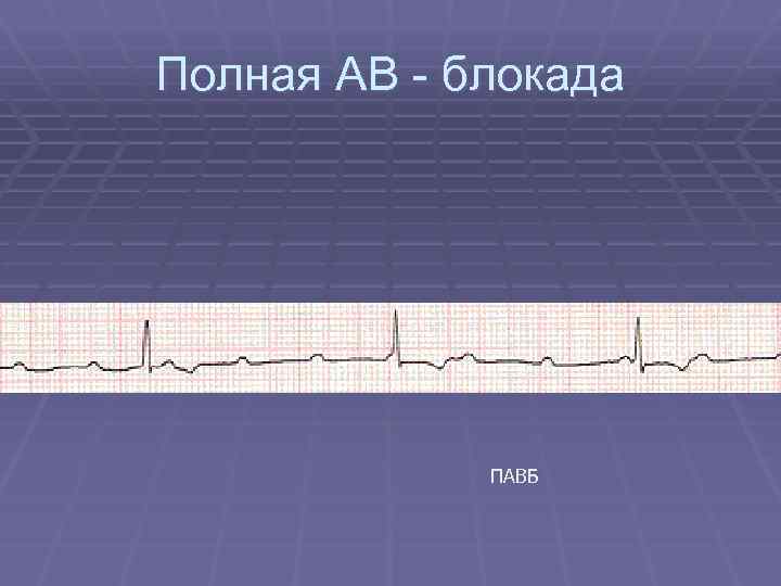 Полная АВ - блокада ПАВБ 