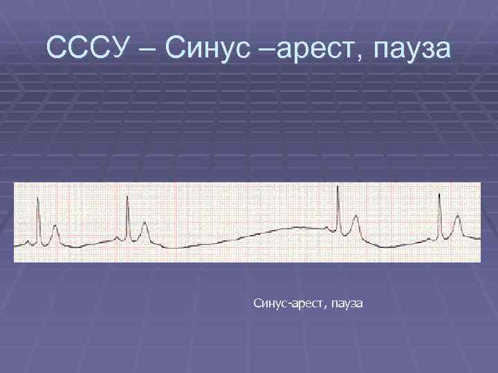 СССУ – Синус –арест, пауза Синус-арест, пауза 