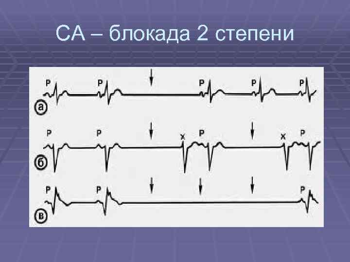 Синоатриальная блокада 2 степени 2 типа