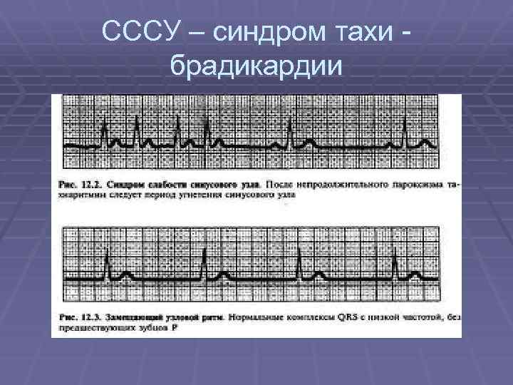 СССУ – синдром тахи брадикардии 