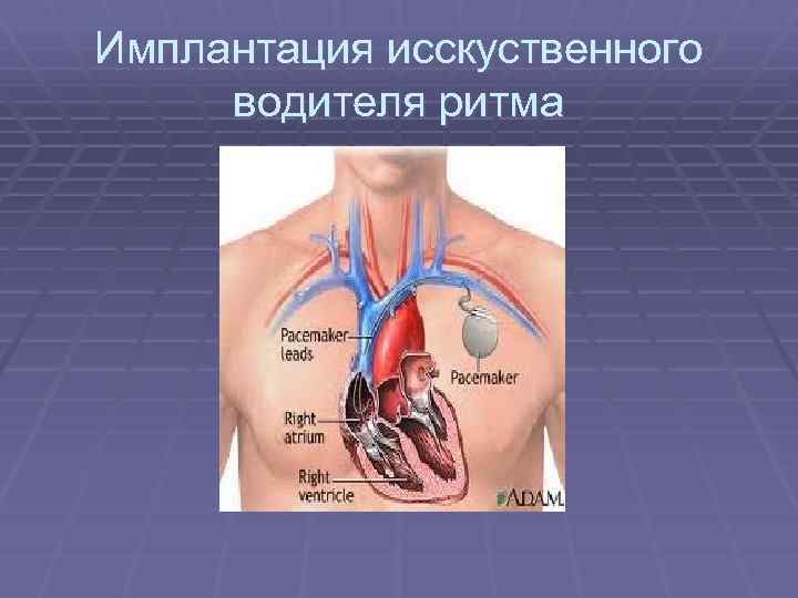 Имплантация исскуственного водителя ритма 