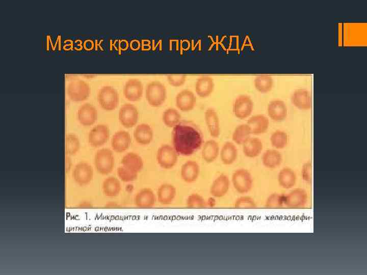 Мазок крови при ЖДА 