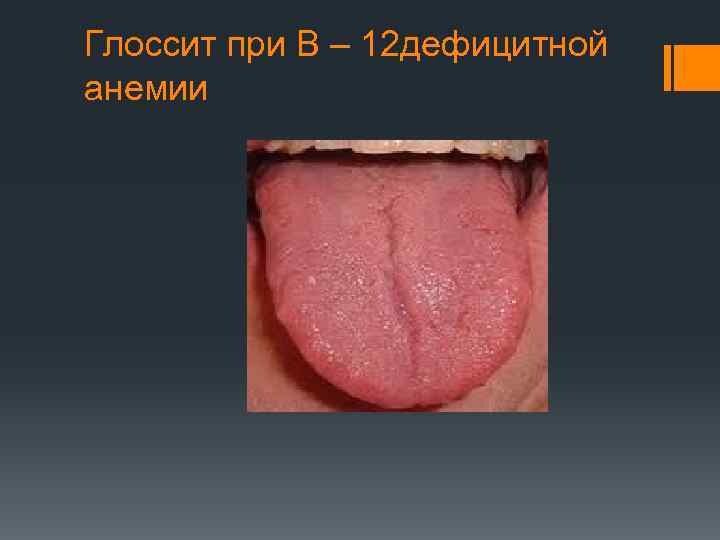 Глоссит при В – 12 дефицитной анемии 