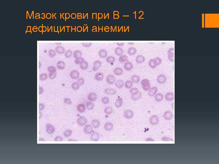 Мазок крови при В – 12 дефицитной анемии 