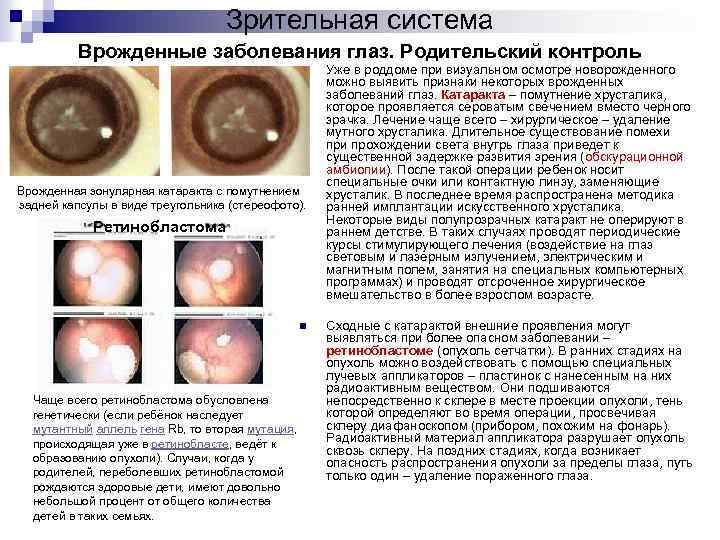 Зрительная система Врожденные заболевания глаз. Родительский контроль n Врожденная зонулярная катаракта с помутнением задней