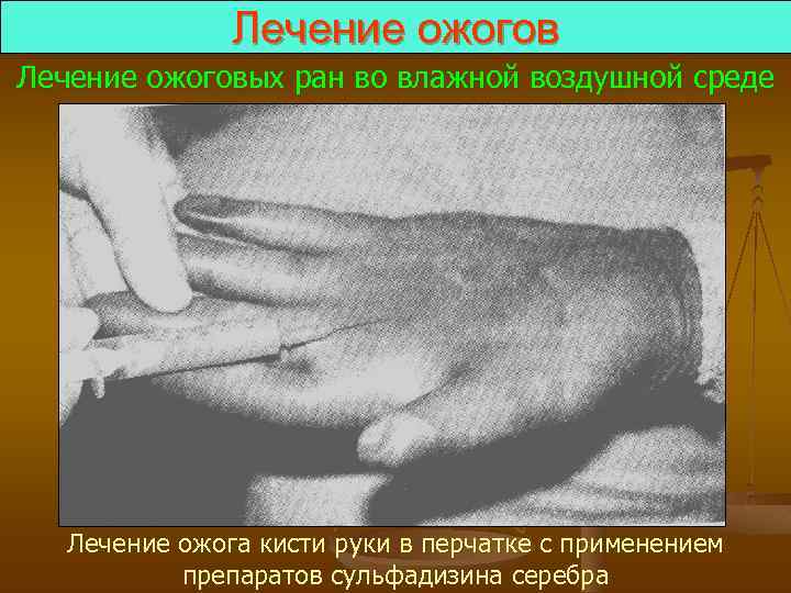 Лечение ожоговых ран во влажной воздушной среде Лечение ожога кисти руки в перчатке с