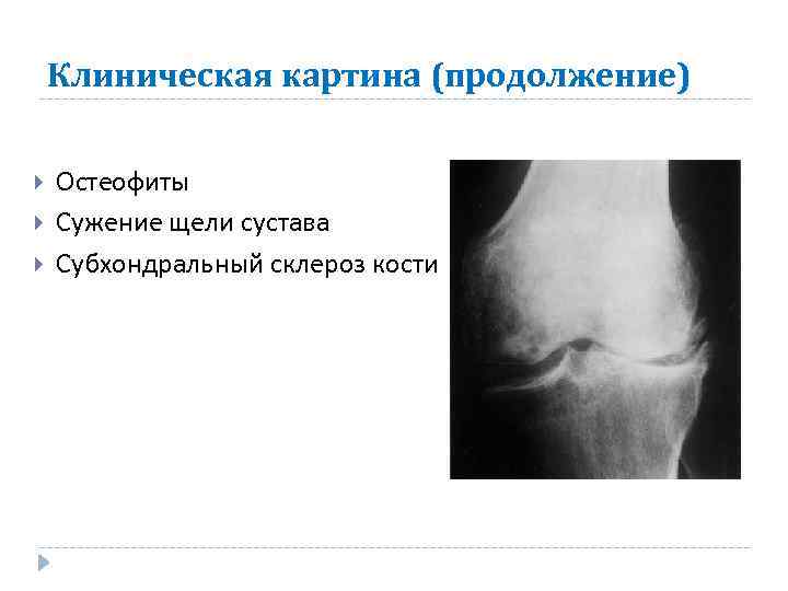 Клиническая картина (продолжение) Остеофиты Сужение щели сустава Субхондральный склероз кости 