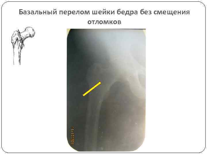 Базальный перелом шейки бедра без смещения отломков 