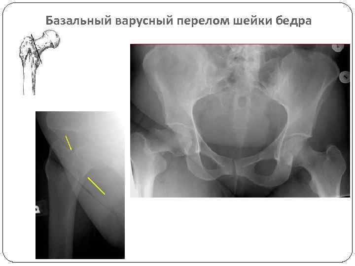 Базальный варусный перелом шейки бедра 