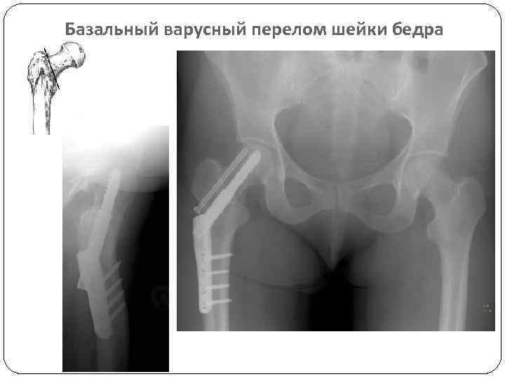 Базальный варусный перелом шейки бедра 