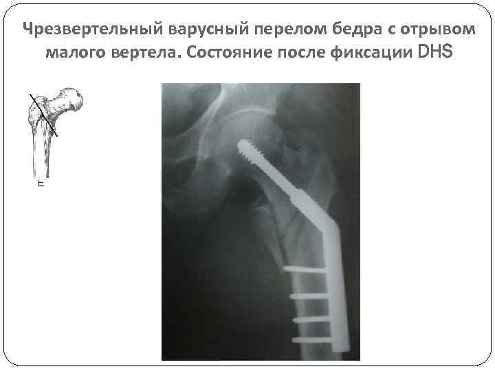 Карта вызова смп перелом бедра