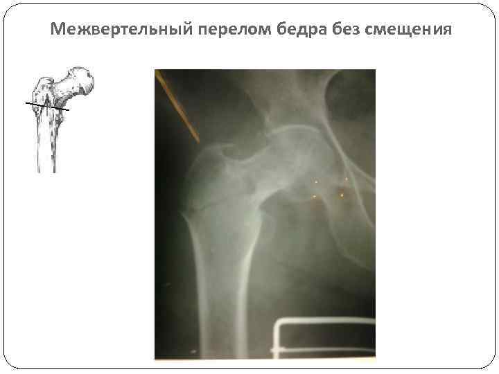 Межвертельный перелом бедра без смещения 