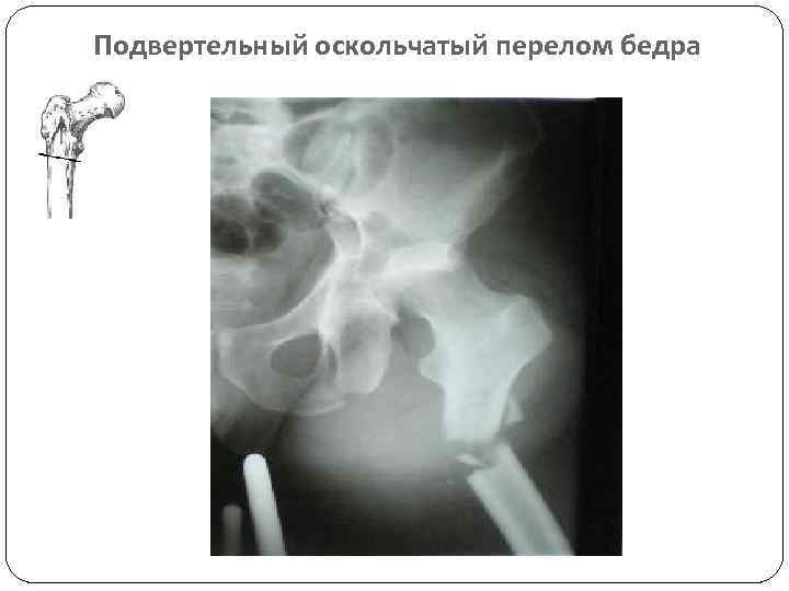 Подвертельный оскольчатый перелом бедра 