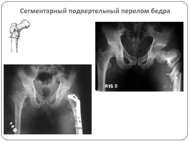 Где находится вертельная кость бедра фото