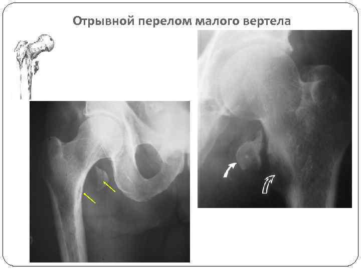 Отрывной перелом малого вертела 