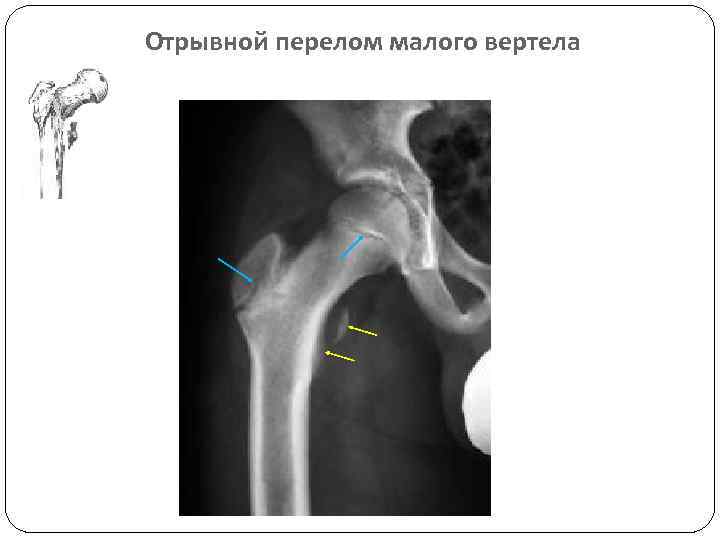 Отрывной перелом малого вертела 