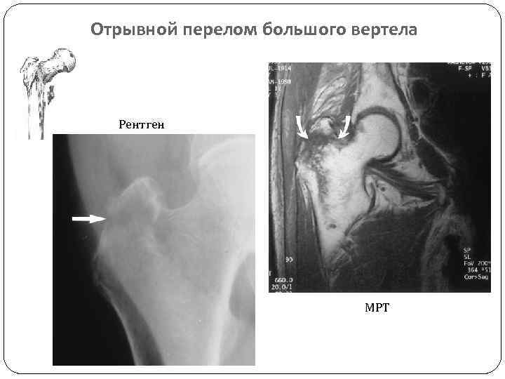 Вертел бедра картинка